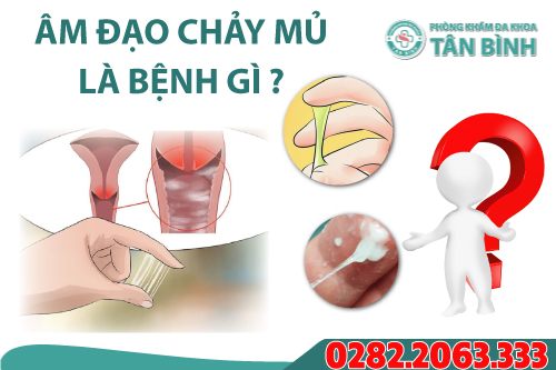 Âm đạo chảy mủ là bị gì