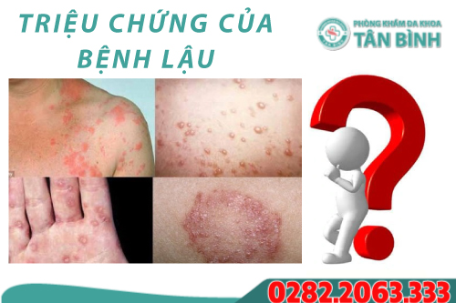 Triệu chứng của bệnh lậu như thế nào?