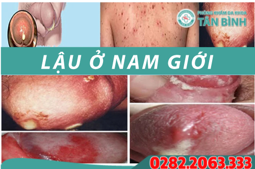 Bệnh lậu ở nam giới triệu chứng và cách điều trị