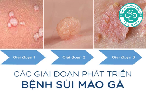 Tìm hiểu các giai đoạn của sùi mào gà