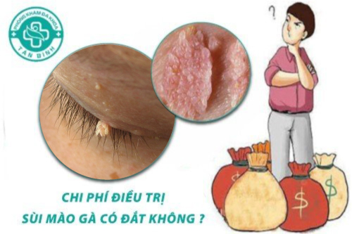 Chi phí điều trị sùi mào gà có đắt không?