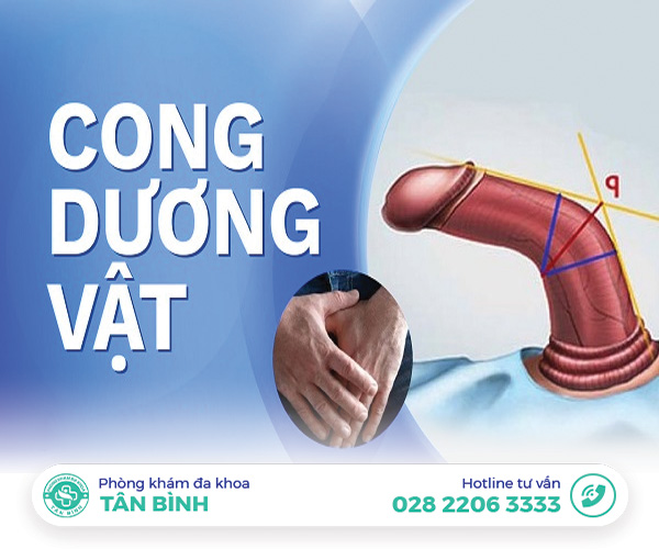 Quý ông và nỗi trăn trở: Cong dương vật có chữa được không?