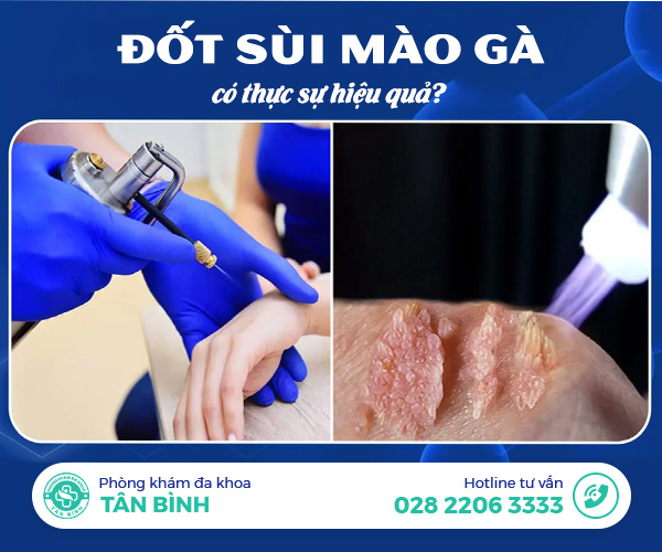 Đốt sùi mào gà có thật sự khỏi hẳn? Sự thật khiến nhiều người bất ngờ