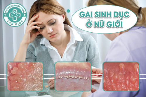 Gai sinh dục ở nữ giới là bệnh gì?