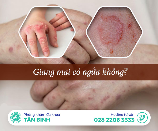 Giải đáp thắc mắc: Giang mai có ngứa không?