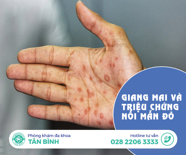 Giang mai và triệu chứng bị nổi mẩn đỏ: Dấu hiệu không nên bỏ qua
