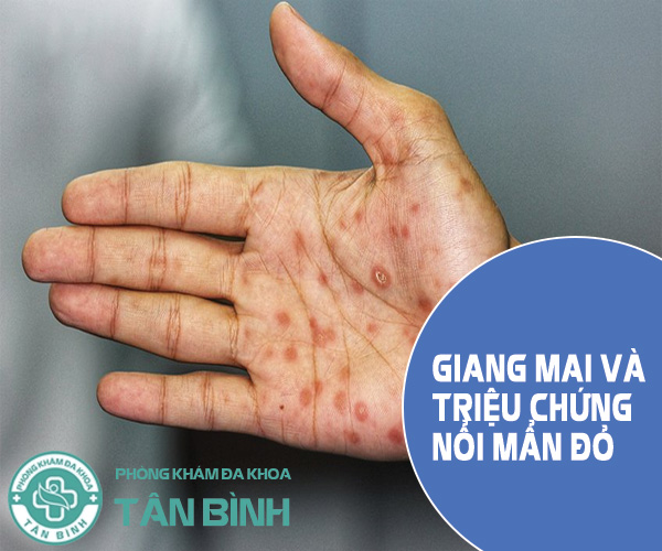 Giang mai và triệu chứng bị nổi mẩn đỏ: Dấu hiệu không nên bỏ qua