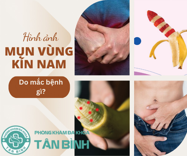 Hình ảnh nổi mụn vùng kín nam - Cần phát hiện và điều trị sớm