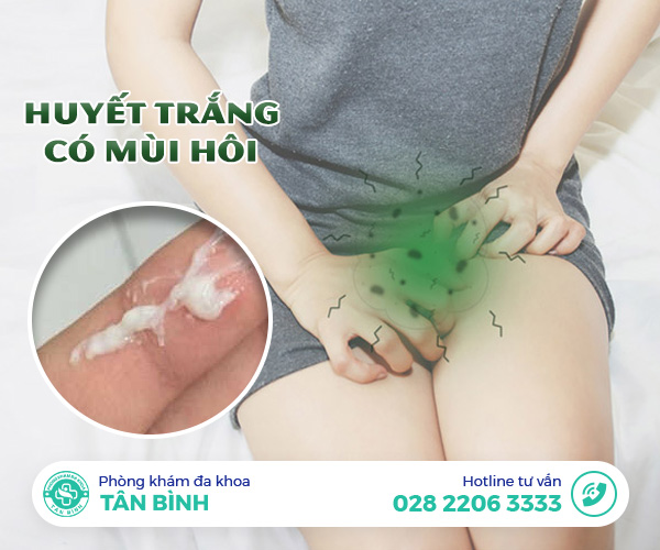 Cẩn thận với huyết trắng có mùi hôi - Tác nhân âm thầm gây vô sinh ở nữ giới