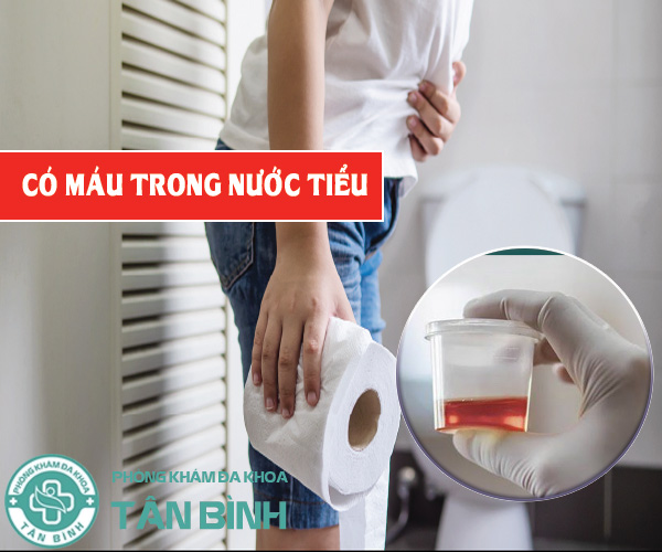 Có máu trong nước tiểu – Dấu hiệu bất thường chớ nên xem thường