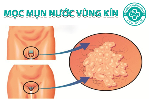 Mọc mụn nước ở vùng kín là do bệnh gì gây ra?