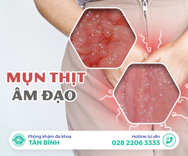 Bị nổi mụn thịt âm đạo là do đâu? Chữa như thế nào?