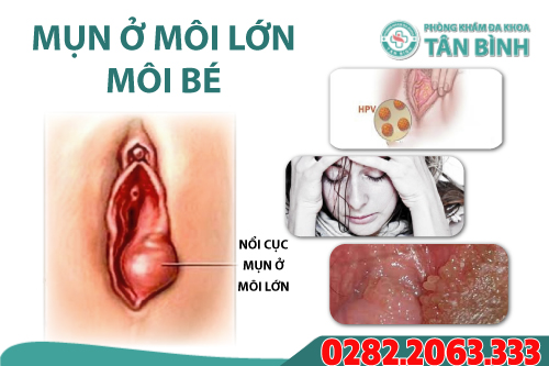 Mụn ở môi bé môi lớn là bệnh gì?