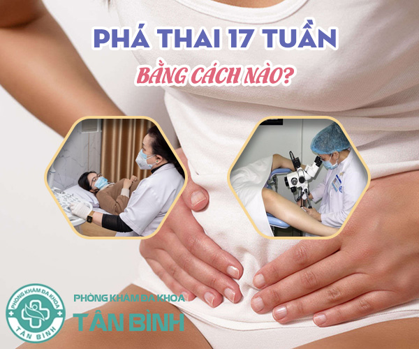 Có cách phá thai 17 tuần an toàn không?