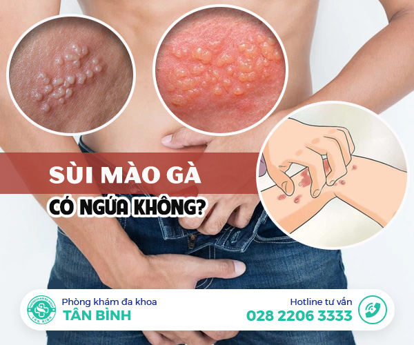 Người bệnh thắc mắc sùi mào gà ngứa không?