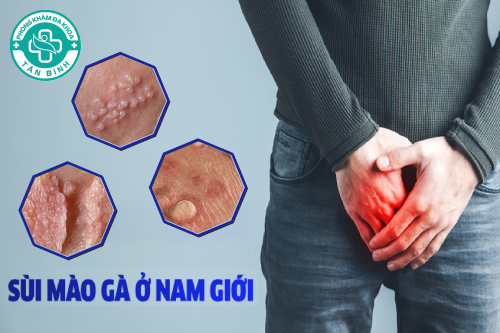 Sùi mào gà ở nam giới và cách điều trị hiệu quả