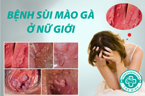 Địa chỉ điều trị sùi mào gà chất lượng hiện nay