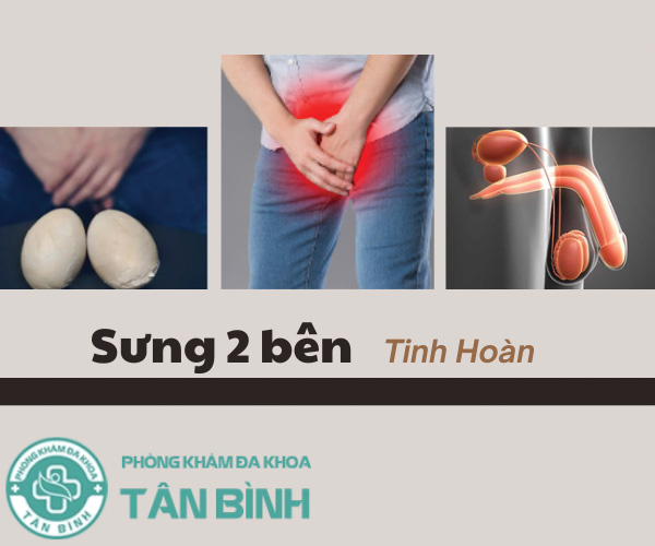 Sưng 2 bên tinh hoàn – Triệu chứng bất thường không nên chủ quan