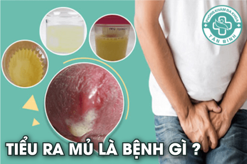 Tiểu ra mủ là bệnh gì?