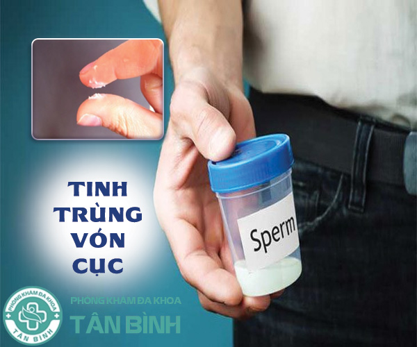 Tình trạng tinh trùng vón cục màu trắng là gì? Có đáng quan ngại không?