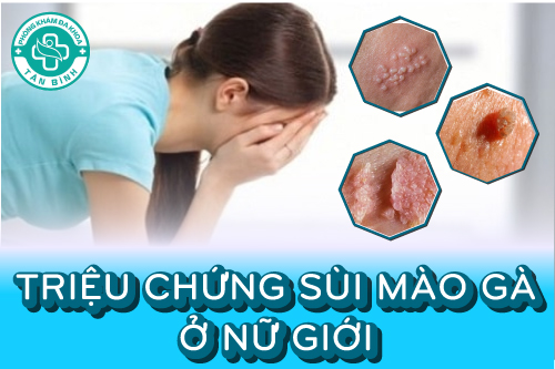 Triệu chứng của bệnh sùi mào gà ở nam giới và nữ giới