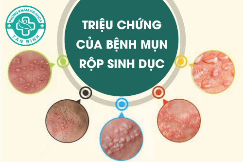 Điều trị mụn rộp sinh dục bằng cách nào?