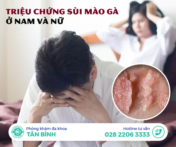 Lưu ý: Một số triệu chứng của bệnh sùi mào gà ở nam giới và nữ giới