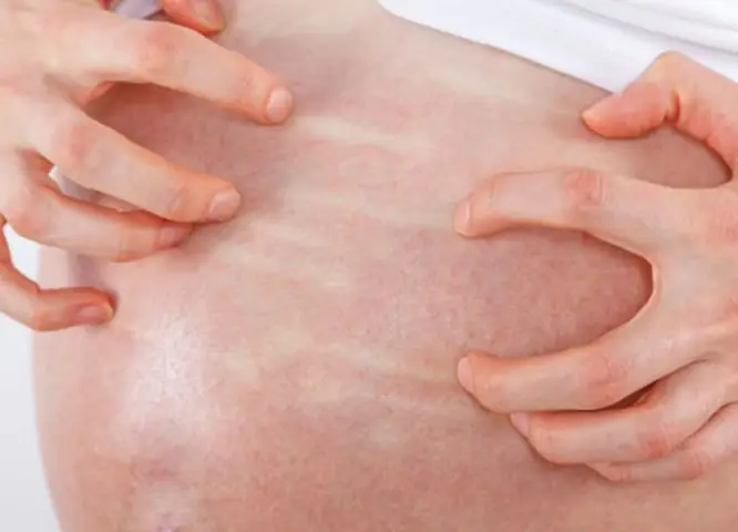 Bà Bầu Bị Dị Ứng Thời Tiết: Nguyên Nhân, Triệu Chứng Và Cách Xử Lý An Toàn Bà Bầu Bị Dị Ứng Thời Tiết: Nguyên Nhân, Triệu Chứng Và Cách Xử Lý An Toàn
