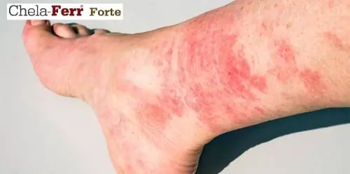 Bà Bầu Bị Nổi Mẩn Ngứa Ở Chân: Nguyên Nhân, Dấu Hiệu Và Cách Xử Lý An Toàn