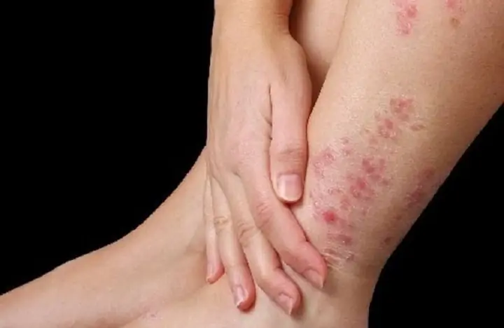 Bà Bầu Bị Nổi Mẩn Ngứa Ở Chân: Nguyên Nhân, Dấu Hiệu Và Cách Xử Lý An Toàn