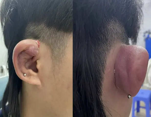 Bấm Lỗ Tai An Toàn: Nên Đến Bệnh Viện Tai Mũi Họng Khi Nào & Địa Chỉ Uy Tín