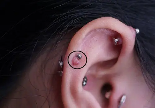 Bấm Lỗ Tai Tại Vinmec: Hướng Dẫn Chi Tiết & Bảng Giá Mới Nhất