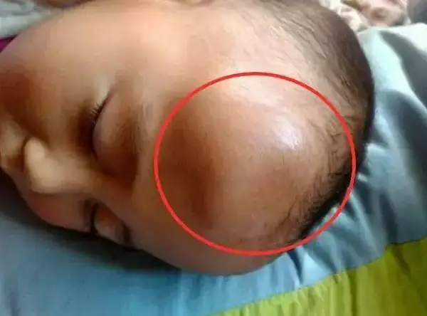 Bé 2 Tuổi Bị Té Đập Đầu Xuống Đất: Dấu Hiệu Nguy Hiểm Và Cách Xử Trí Đúng