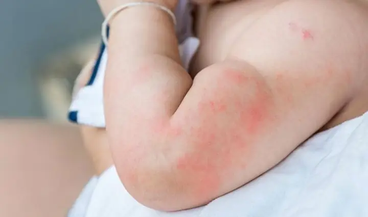 Bé Bị Dị Ứng Sữa Tắm: Dấu Hiệu, Nguyên Nhân Và Cách Xử Lý Hiệu Quả Cho Bé Yêu