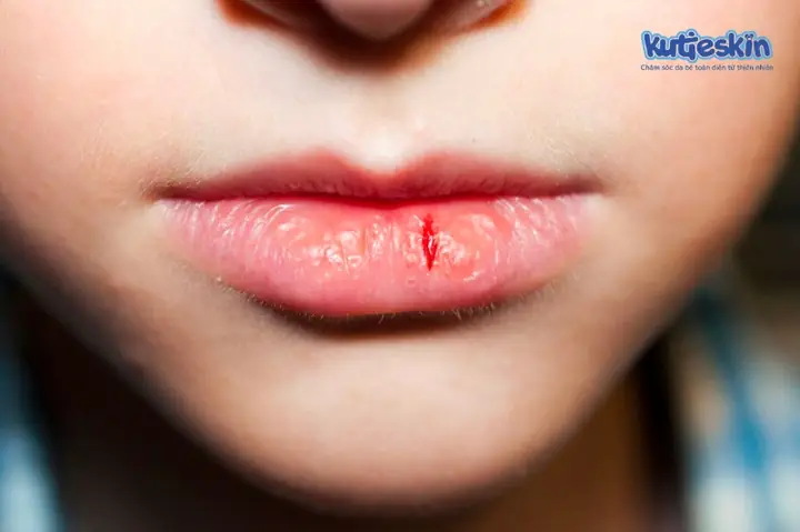Bé Bị Khô Môi Chảy Máu: Nguyên Nhân, Dấu Hiệu Và Cách Chữa Trị An Toàn Cho Trẻ