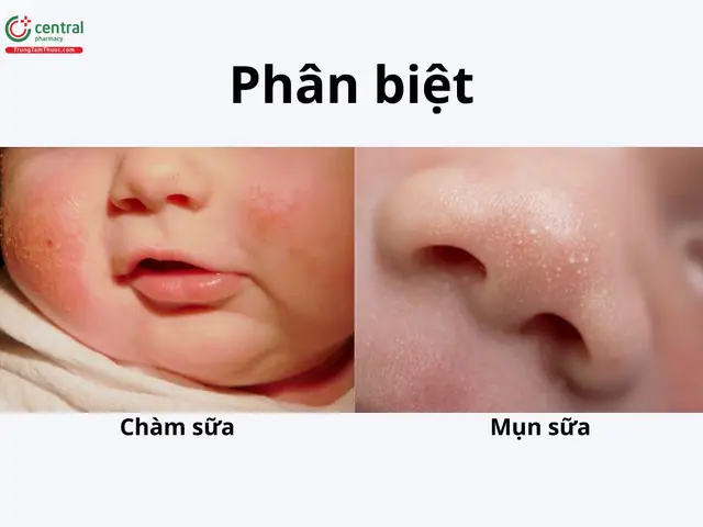 Bé Bị Mụn Sữa Bôi Thuốc Gì Tốt? Hướng Dẫn Lựa Chọn Và Sử Dụng An Toàn