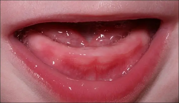 Bé Mọc Răng Sốt Tiêu Chảy: Dấu Hiệu, Nguyên Nhân Và Cách Xử Lý An Toàn Cho Bé