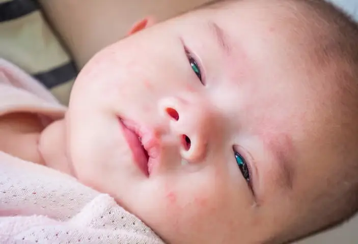 Bé Sơ Sinh Bị Đỏ Mắt: Nguyên Nhân, Triệu Chứng Và Cách Chữa Trị An Toàn Tại Nhà