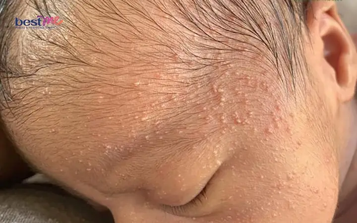 Bé Sơ Sinh Nổi Mụn Nước Trên Đầu: Nguyên Nhân, Cách Chăm Sóc An Toàn Và Khi Nào Cần Đi Khám Bé Sơ Sinh Nổi Mụn Nước Trên Đầu: Nguyên Nhân, Cách Chăm Sóc An Toàn Và Khi Nào Cần Đi Khám