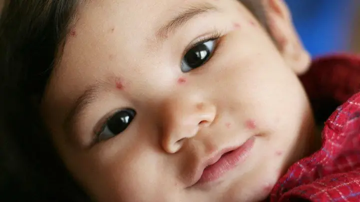Bệnh Đậu Mùa Ở Trẻ Em: Dấu Hiệu, Nguyên Nhân Và Cách Điều Trị An Toàn
