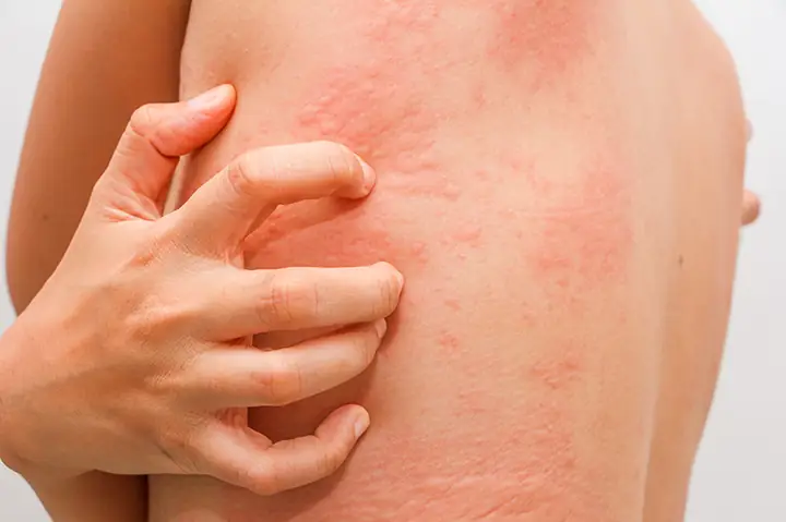 Dị Ứng Thai Kỳ: Nguyên Nhân, Triệu Chứng Và Cách Xử Lý An Toàn Cho Mẹ Bầu