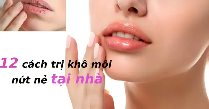 Bị Khô Môi Phải Làm Sao? 15+ Cách Trị Khô Môi Nứt Nẻ Hiệu Quả Tại Nhà