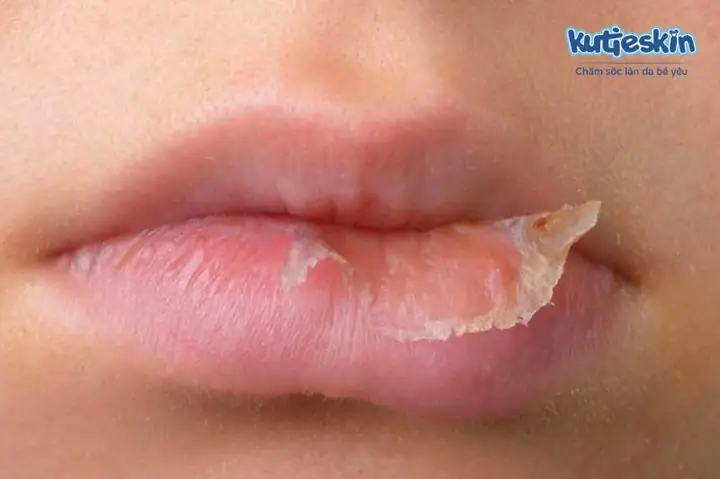 Bị Khô Môi Phải Làm Sao? 15+ Cách Trị Khô Môi Nứt Nẻ Hiệu Quả Tại Nhà