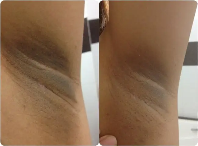 Thâm Nách Khi Mang Thai: Nguyên Nhân, Cách Xử Lý An Toàn Và Hiệu Quả Cho Mẹ Bầu Thâm Nách Khi Mang Thai: Nguyên Nhân, Cách Xử Lý An Toàn Và Hiệu Quả Cho Mẹ Bầu
