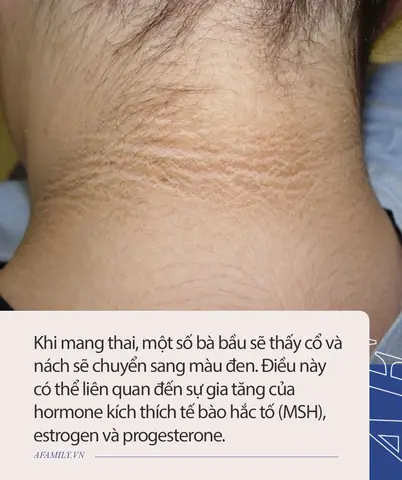 Bà Bầu Bị Thâm Nách Và Cổ Khi Mang Thai: Nguyên Nhân, Cách Xử Lý An Toàn Và Hiệu Quả