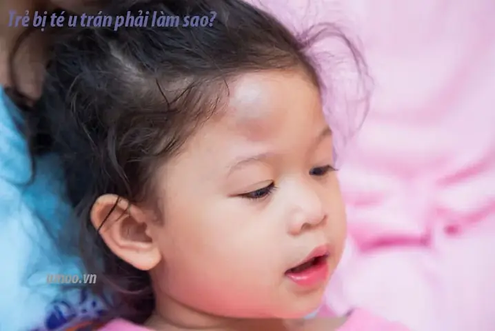 Bị U Đầu Phải Làm Sao? Hướng Dẫn Xử Lý Khi Va Chạm & Nguy Cơ Cần Biết Bị U Đầu Phải Làm Sao? Hướng Dẫn Xử Lý Khi Va Chạm & Nguy Cơ Cần Biết