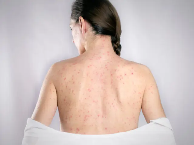 Biểu Hiện Của Bệnh Rubella Ở Bà Bầu: Nhận Biết Sớm, Bảo Vệ Thai Kỳ Khỏi Nguy Cơ Bẩm Sinh