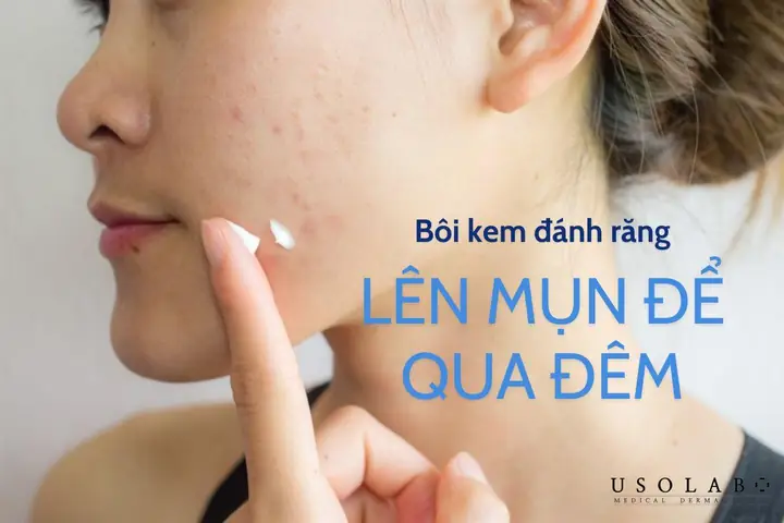 Bôi Kem Trị Mụn Qua Đêm Đúng Cách: Hướng Dẫn Tối Ưu Hiệu Quả Bôi Kem Trị Mụn Qua Đêm Đúng Cách: Hướng Dẫn Tối Ưu Hiệu Quả