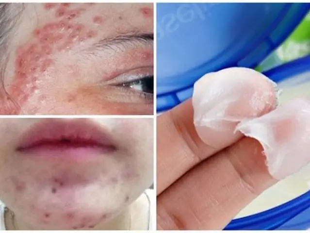 Bôi Vaseline Lên Mặt Qua Đêm: Lợi Ích, Rủi Ro Và Cách Sử Dụng Hiệu Quả