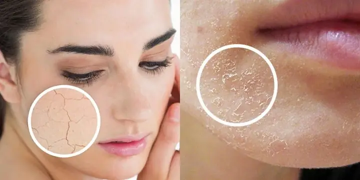 Bong Tróc Da Mặt Là Bệnh Gì? Nguyên Nhân, Dấu Hiệu Và Cách Khắc Phục Hiệu Quả
